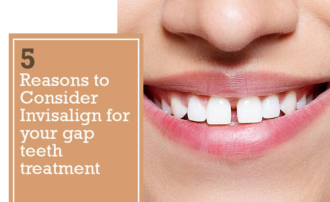 5 Reasons to Consider Invisalign for your gap teeth treatment