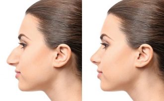 The Course and Procedure of Rhinoplasty in Turkey