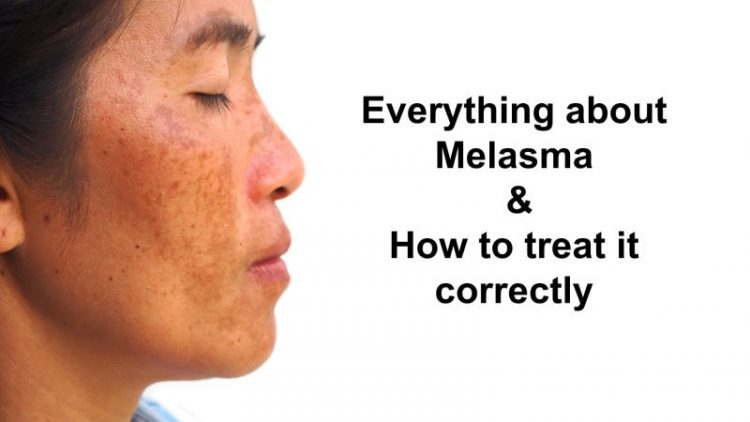 melasma_treatment