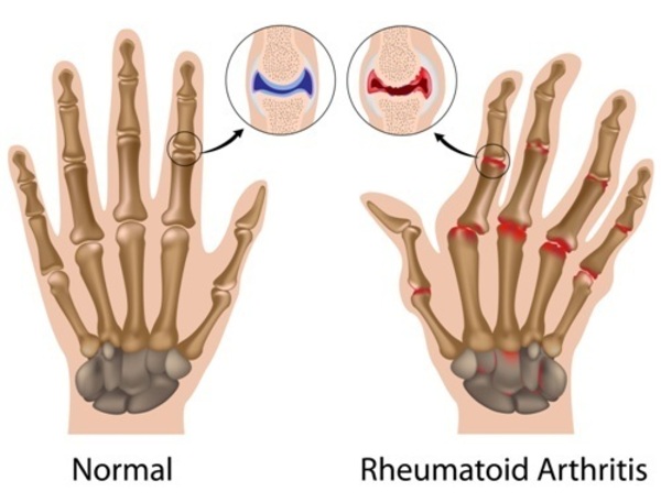 New Way To A Progressive And Best Ayurvedic Treatment For Rheumatoid Arthritis