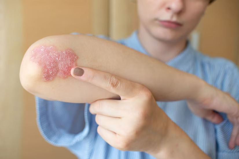 From Aloe Vera to Coconut Oil: The Best Natural Remedies for Psoriasis Symptoms