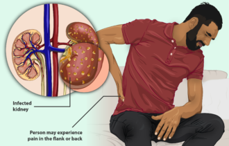 Flank pain is a sign of Kidney Stones: Treatment options explained by the best Nephrologist in Delhi NCR