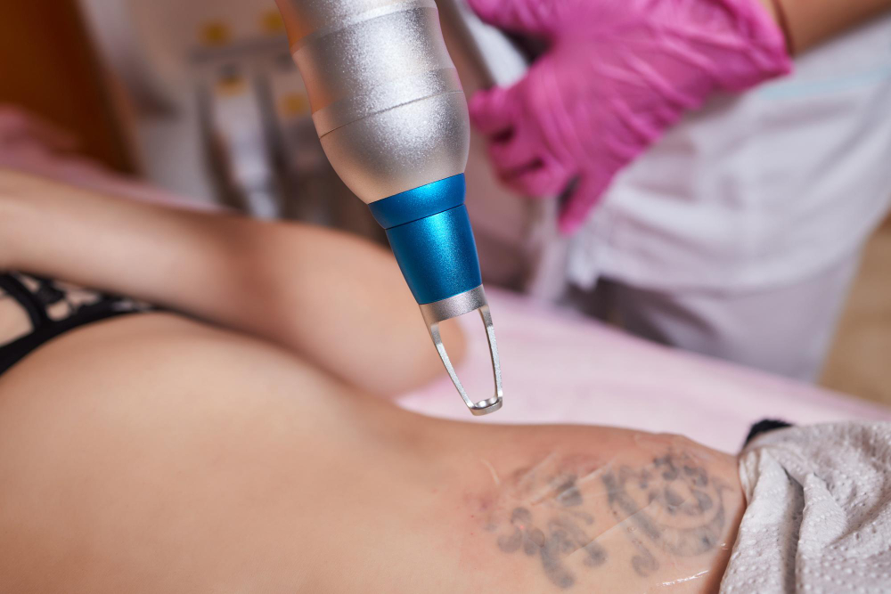 Tattoo Removal Practices